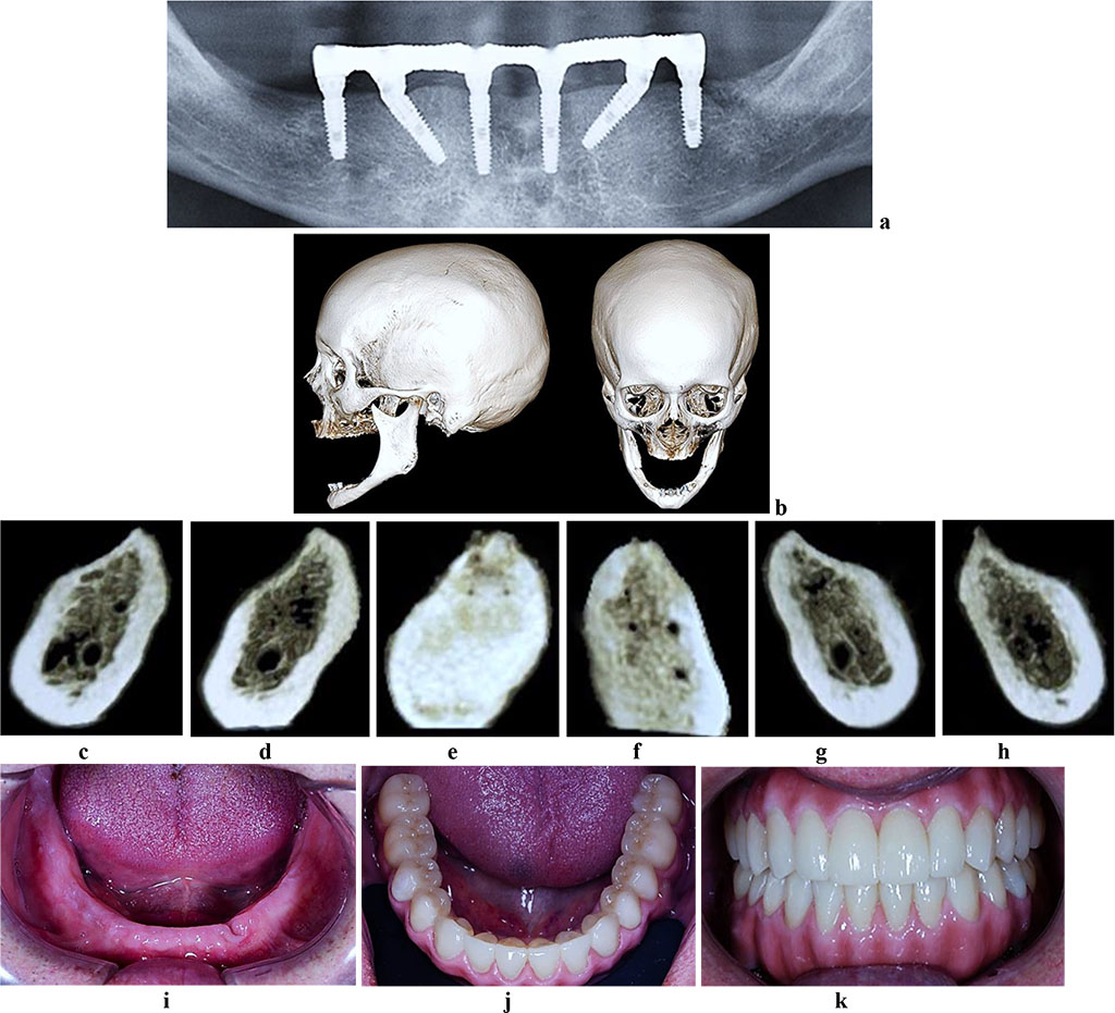 Figure 8. Patient S., 62 y.o. Diagnosis: lower jaw total adentia; Class I by Keller. Lower jaw CBCT: a – bone tissue 12 months following the installation of dental implants (panoramic reformat); b – volume rendering; 3D cross-sections at the adentia area 3.2 (c), 3.4 (d), 3.6 (е), 4.2 (f), 4.4 (g), 4.6 (h) prior to the installation of dental implants; lower dentition before (i) and after (j, k) implantological and prosthetic treatment.