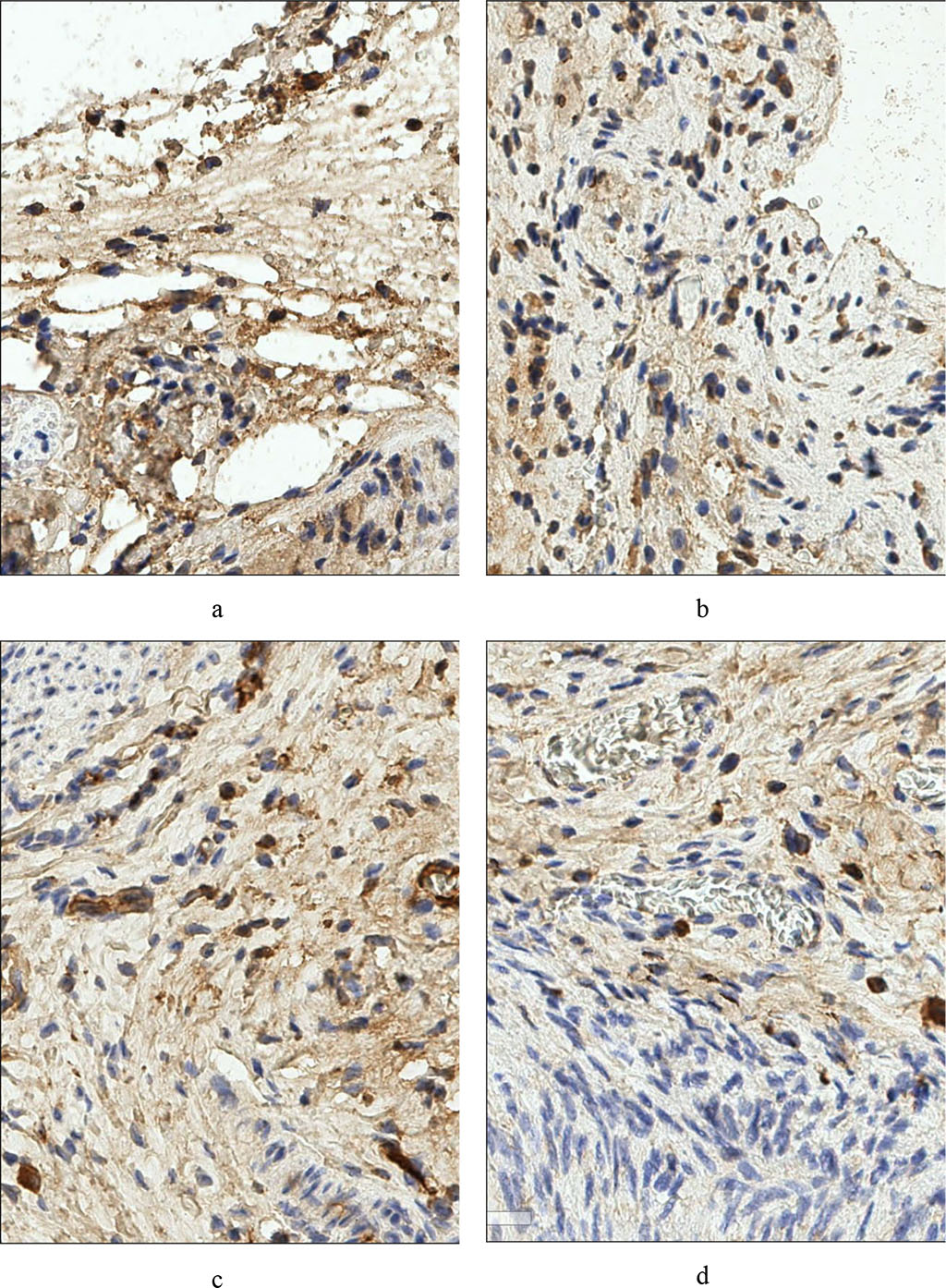 Fig. 1 – Rat's peritoneum. Expression of the marker CD4+ a - before treatment, b - after treatment. Rat parametry. Expression of CD138+ c marker - pre-treatment, d – post-treatment (×400)
