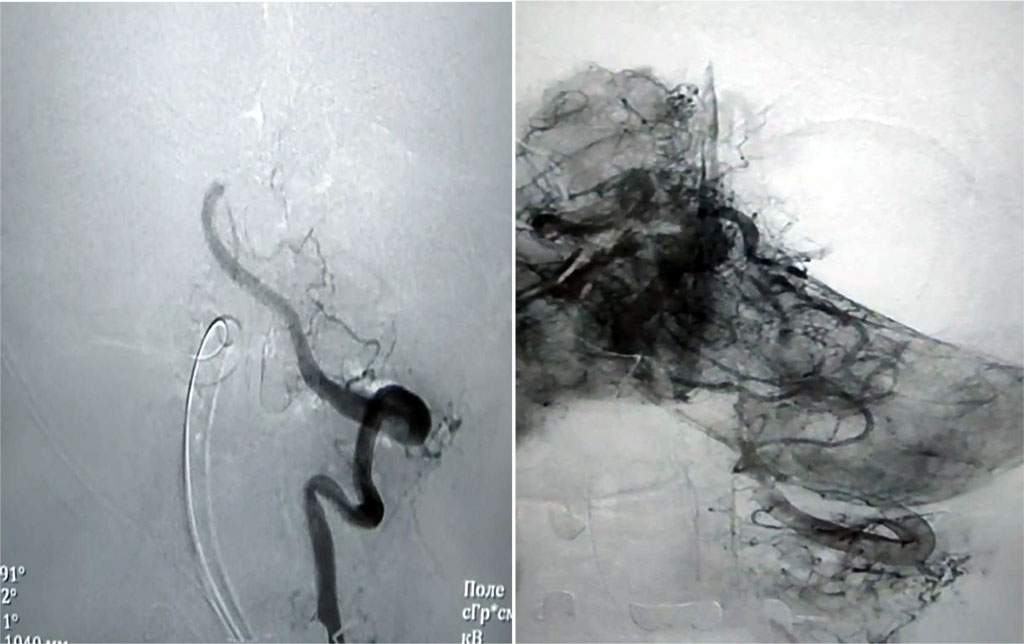 Figure 1. Angiography of the cranial vessels before surgery 