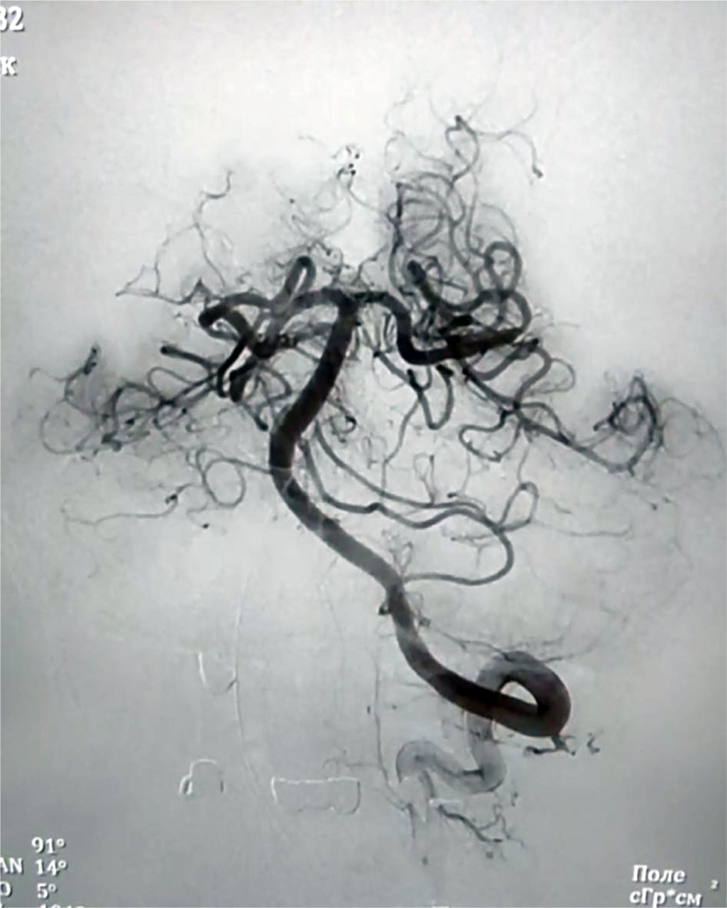Figure 2. Angiography of the cranial vessels after balloon dilatation and stenting