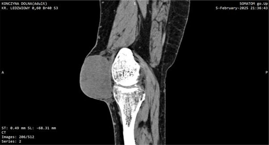 Figure 1: CT scan of the knee joint with Myxofibrosarcoma (MFS). Sagittal plane.