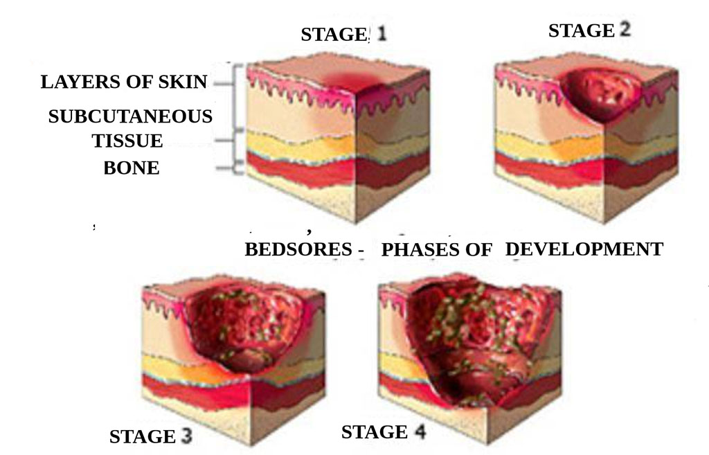 Figure 1. Stages of Pressure Injury Development