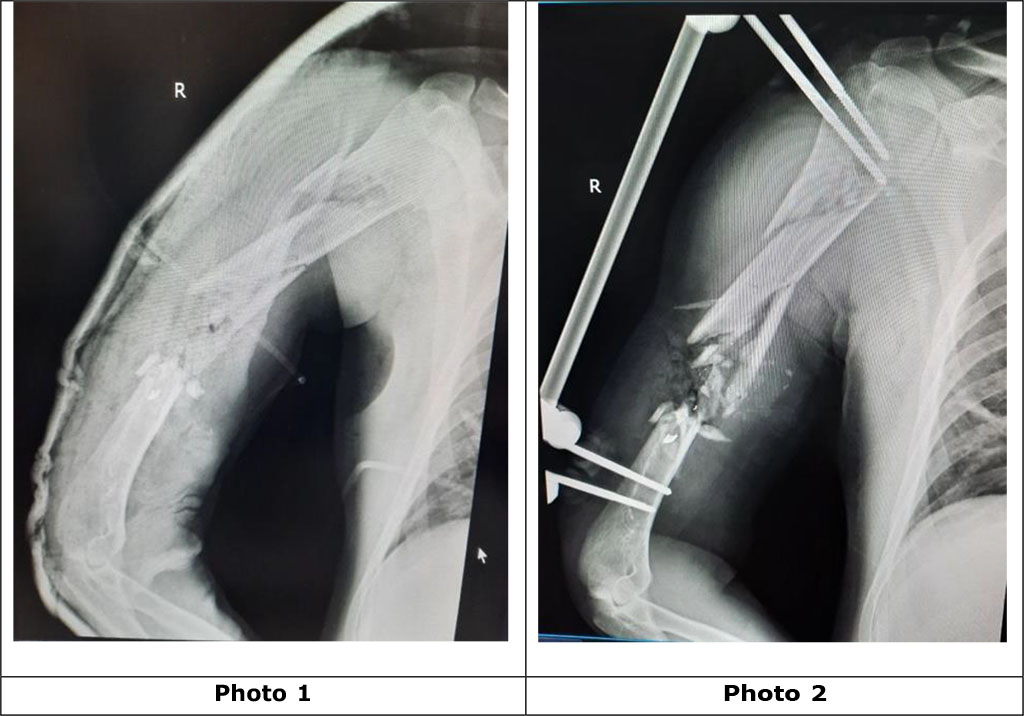 Photo 1. Radiographs of the right shoulder with a gunshot multifragmentary fracture along the middle and upper third of the diaphysis of the humerus with displacement of the fragments, a defect in the bone structure, and foreign bodies (metal fragments) before the operation