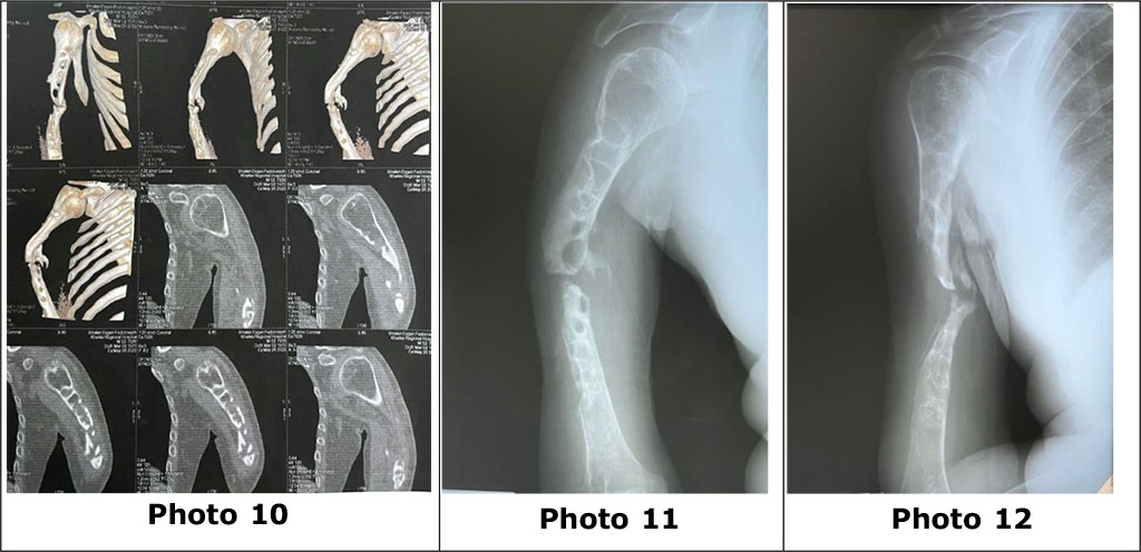 Photo 10 - computer tomography, photos 11, 12 - radiographs of the right humerus with signs of the formation of a false joint in the middle third of the humerus, pronounced sclerosis and pathological osteolytic cavities of the proximal and distal parts of the right humerus.