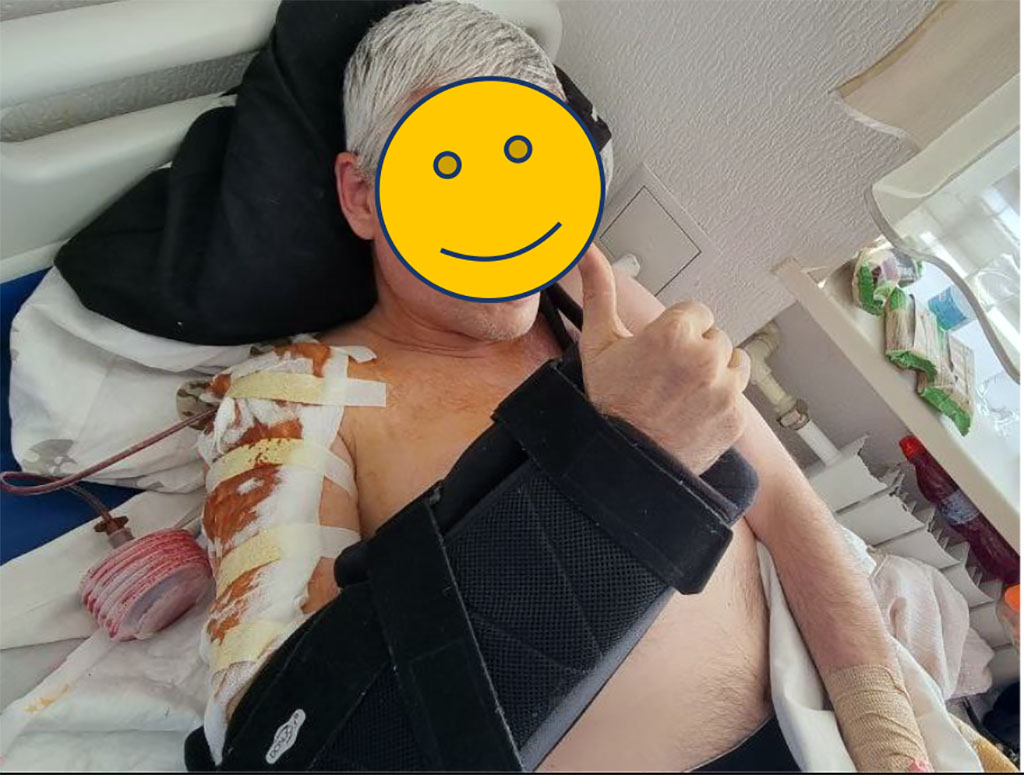 Photo 28. General view of the patient and his right hand, indicating the absence of neuropathy of the right radial nerve.