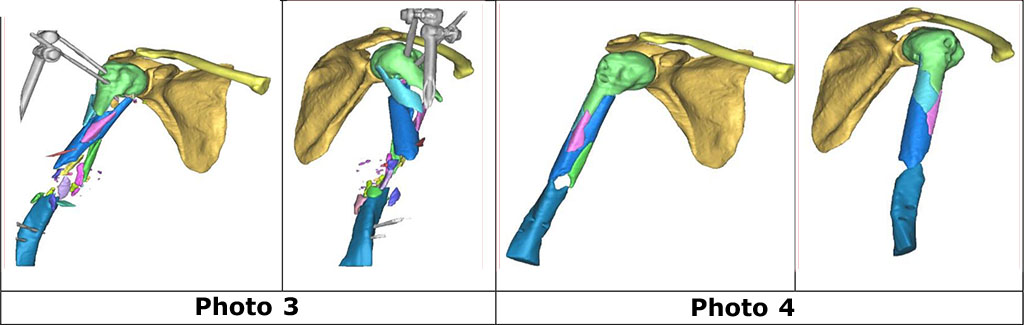 Photos 3 and 4. Digital model of the right shoulder before (3) and after (4) virtual repositioning of bone fragments of the right humerus.