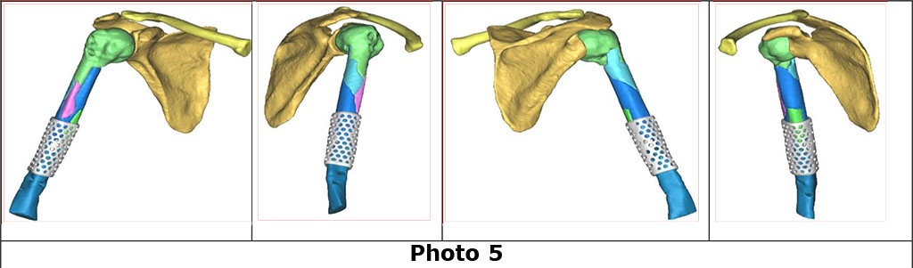 Photo 5. Virtual image of a PEEK grid following 3D modeling using SOFTWARE MATERIALIZE MIMICS INNOVATION SUITE as a stage of preoperative planning. Using the software, the diameter of the humeral canal was determined to select the appropriate size of the intramedullary rod, which was 10.1 mm (photo 6).