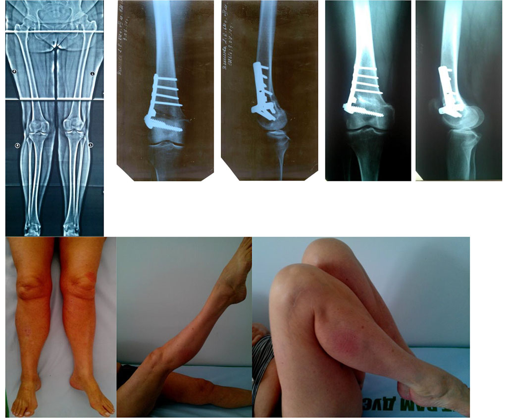 Figure 1. X-ray images of the knee before and after surgery. Functions of the right lower limb 18 months later.
