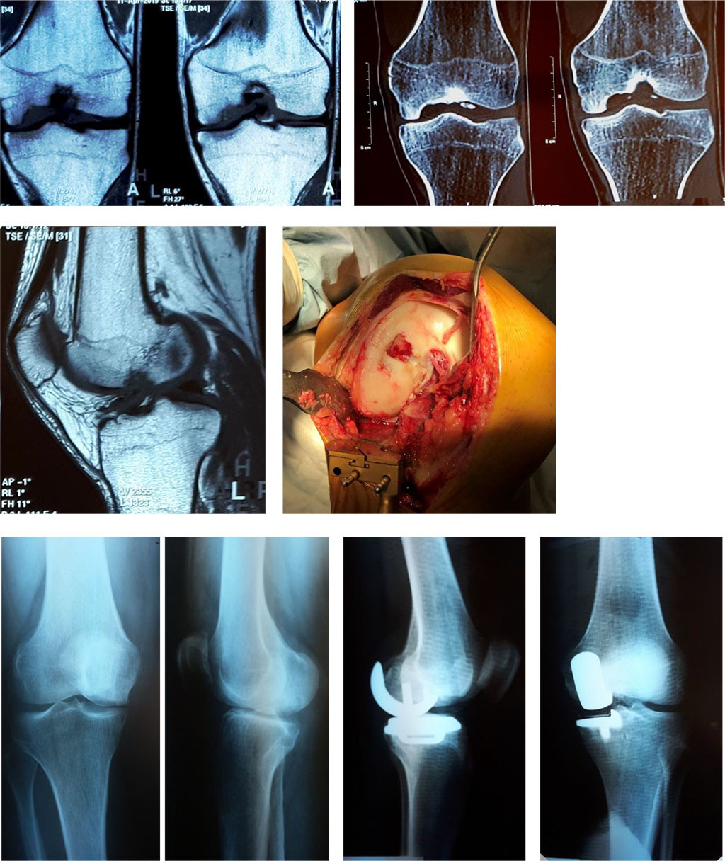 Figure 2. MRI, CT of a knee, intraoperative photo of a defect of medial femoral condyle and X-ray image of the lower limb after the unicondylar arthroplasty. 