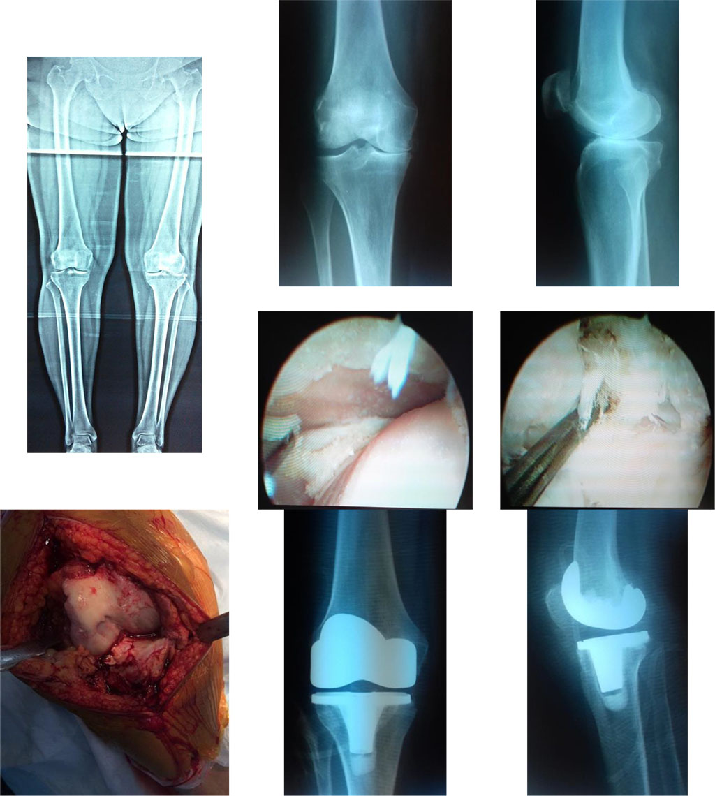 Figure 3. X-ray images before and after total knee arthroplasty. An intraoperative image (the defect of the medial femoral condyle).