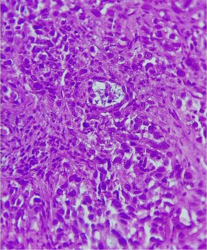 Fig.1. Poorly differentiated squamous cell carcinoma (G3). Pseudo glandular area. H&Ex400