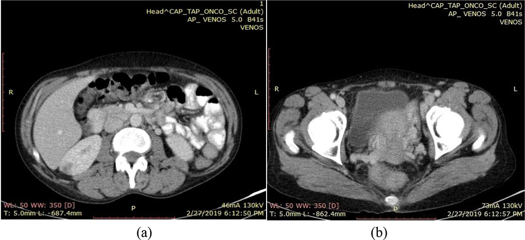 Fig.2. CT scan February 2019 - (a) a right renal, poorly iodophilic, heterogeneous image, and (b) globular cervix – 33mm.