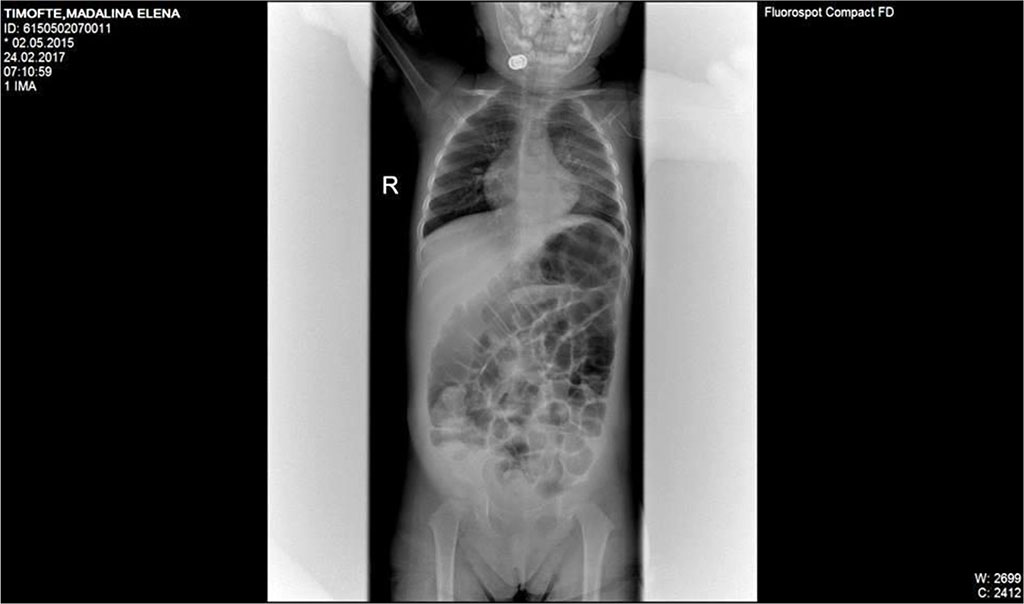 Fig.1. Dilated bowel loops, two c on the left iliac fossa; absence of pneumoperitoneum