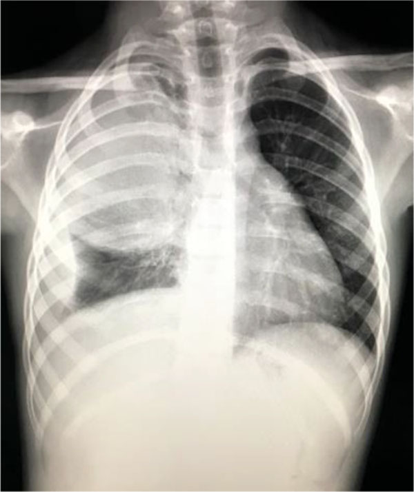 Fig. 4. Opacity located on the upper right pulmonary lobe and presence of fluid in the right costo-diafragmatic sinus