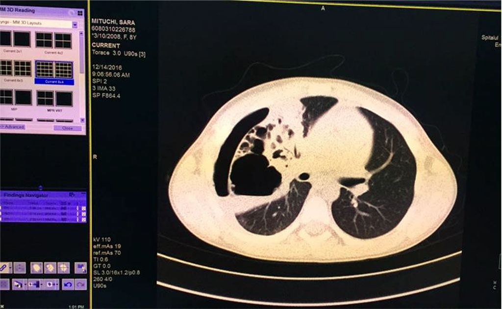 Fig. 7. Pulmonary consolidation, inhomogenous, with multiple aeric cysts with sizes from 11mm to 42.3mm