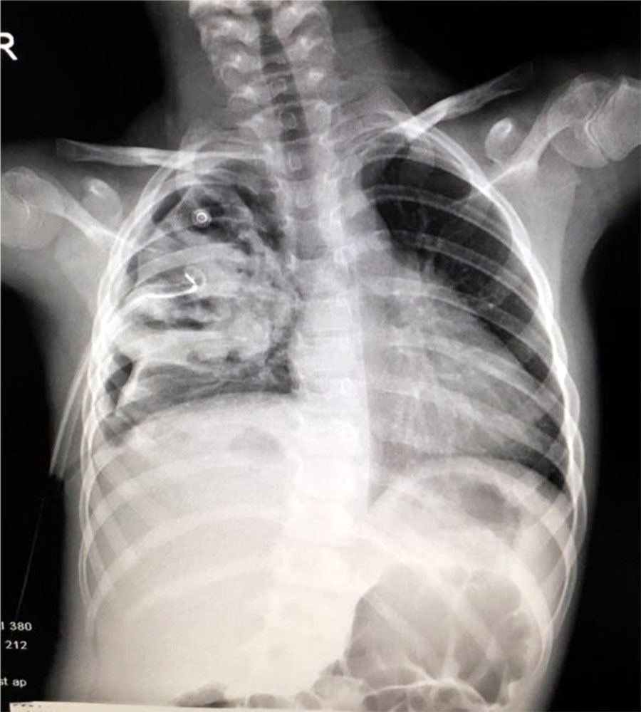 Fig. 8. Non-homogeneous opacity in medium 2/3 of the right hemithorax