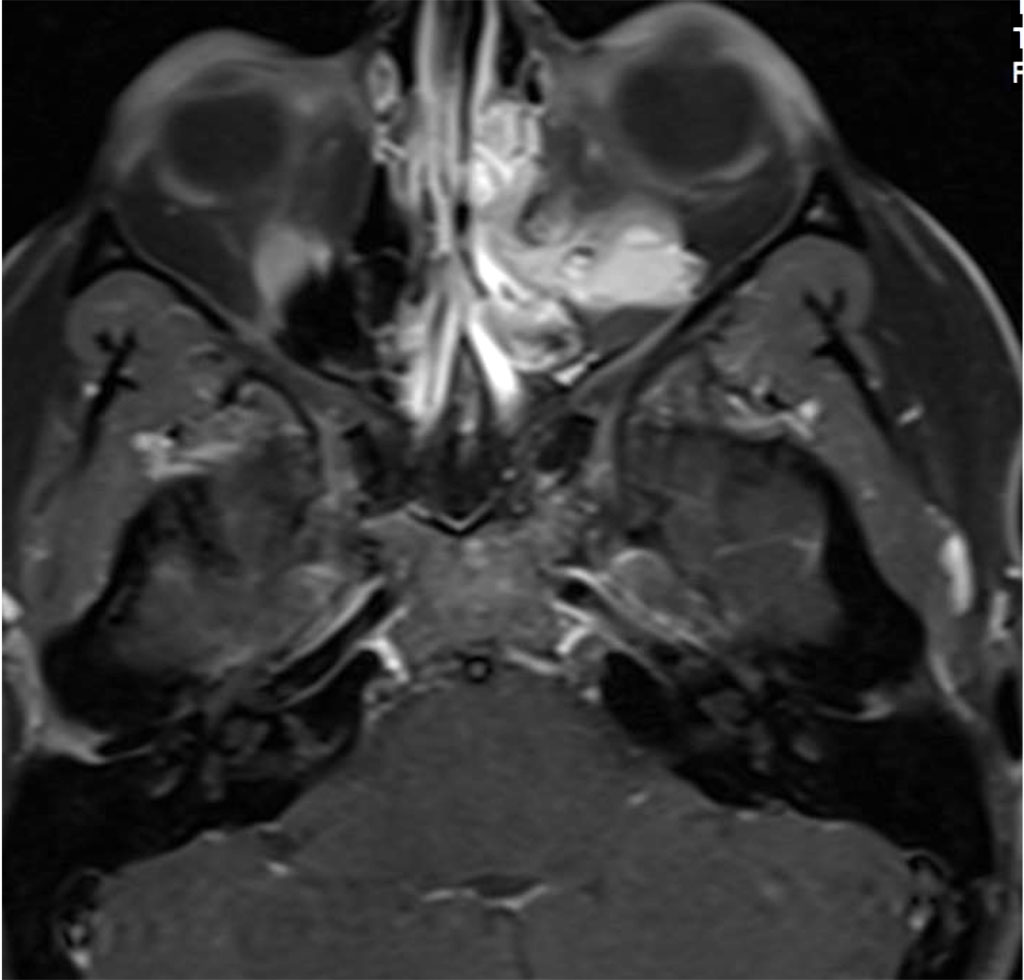 Figure 2a: Axial MR T1 with contrast demonstrating intra and extraconal orbital lesion