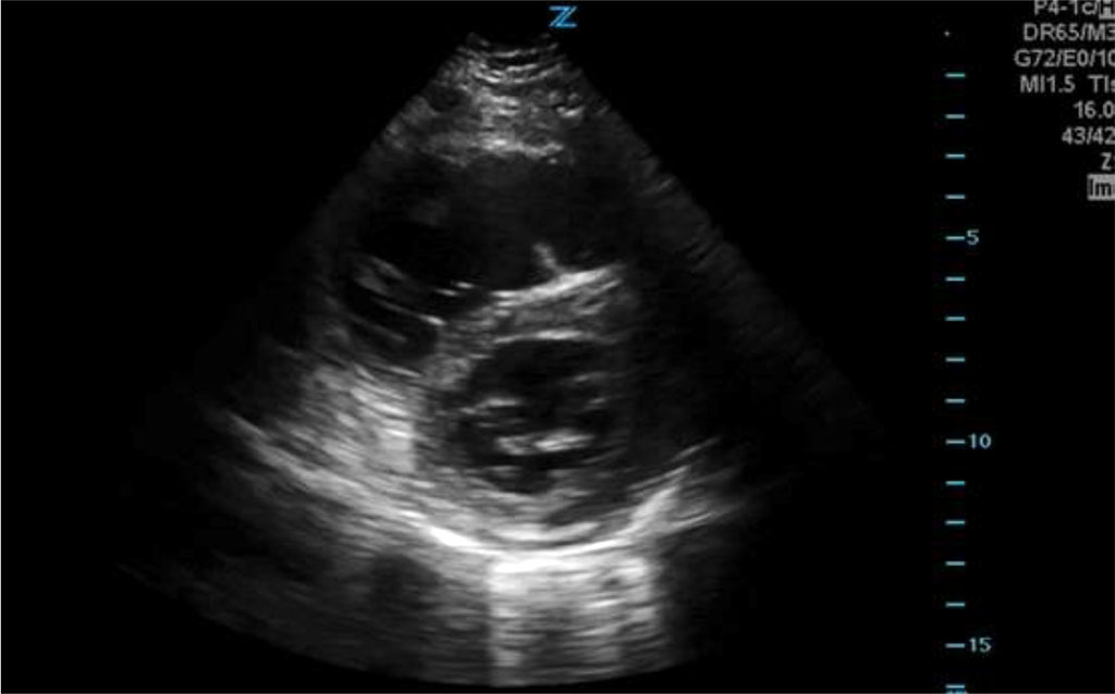 Fig.1 Echocardiographic image showing right ventricular overload