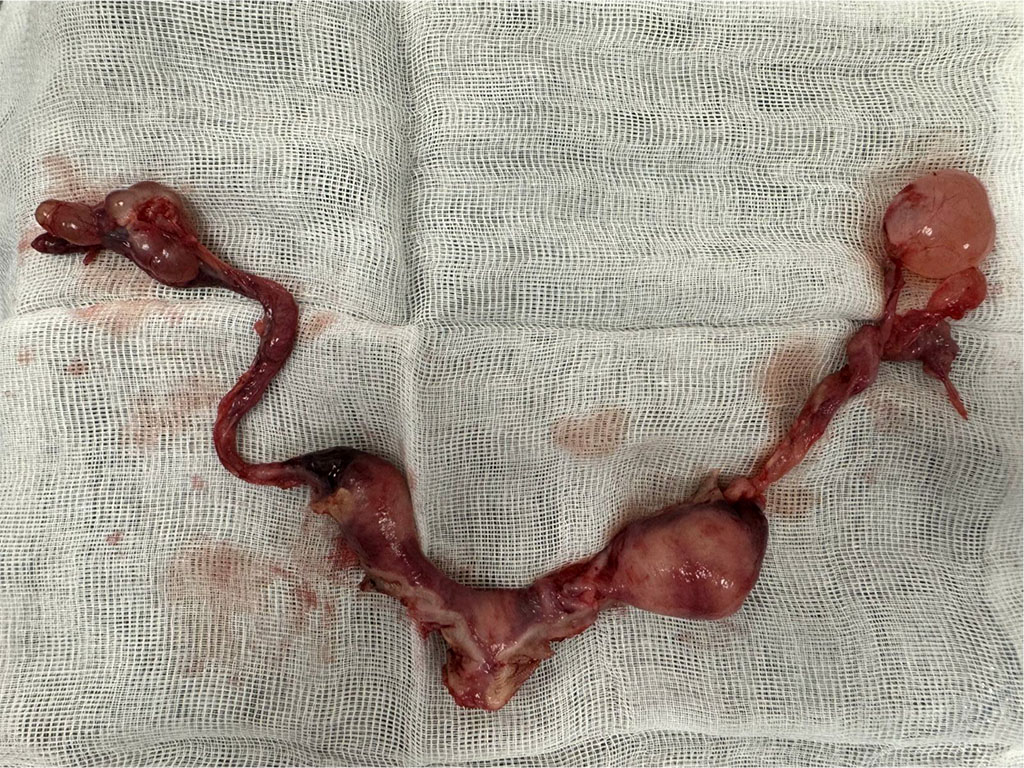 Figure 3. Laparoscopically removed vestigial uterine horns together with fallopian tubes and paratubal cyst