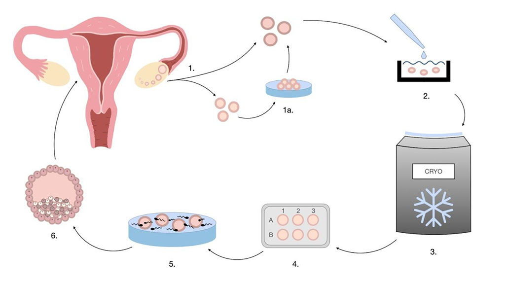 Figure 1. Puncture of the adequately developed follicles with an aspiration needle under ultrasound guidance after earlier stimulation of the ovaries with injectable hormones and selection of mature or immature oocytes. 1a. Immature oocyte in vitro maturation. 2. Mobilization of water out of the oocytes and diffusion of cryoprotectants into the oocytes to prevent formation of ice crystals. 3. Cryopreservation by rapid vitrification with the use of liquid nitrogen or by slow cooling method and storage of cryopreserved oocytes in nitrogen tanks. 4. Thawing. 5. In vitro fertilization. 6. Embryos. [18] [19]