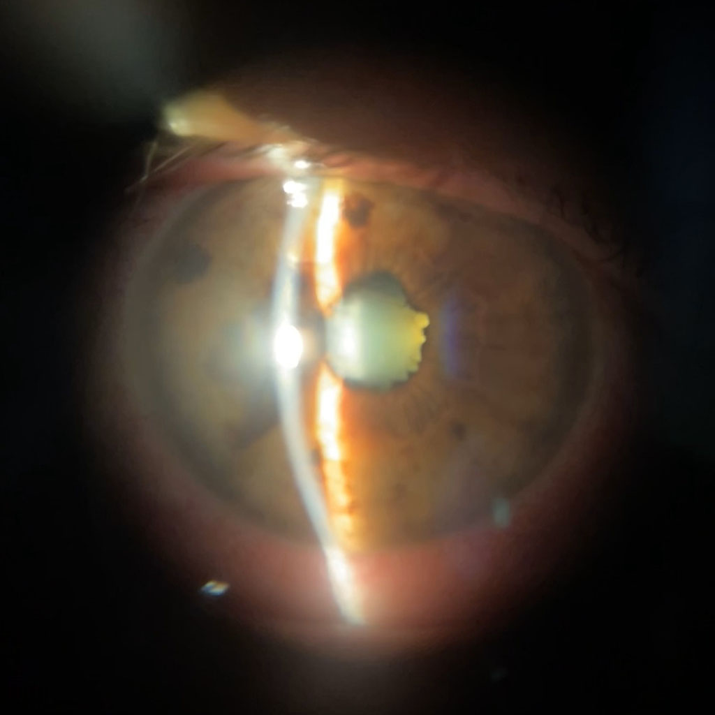 Figure 1. Posterior synechiae in active acute anterior uveitis