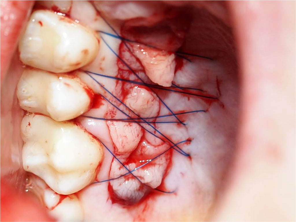 Fig.6 Post-suturing condition of the palatal wound (secured with crossed mattress sutures using non-resorbable 5-0 thread).