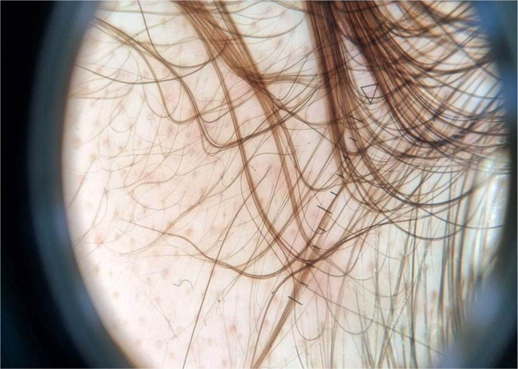 Figure 1: Sample trichoscopic image of a patient with androgenetic alopecia