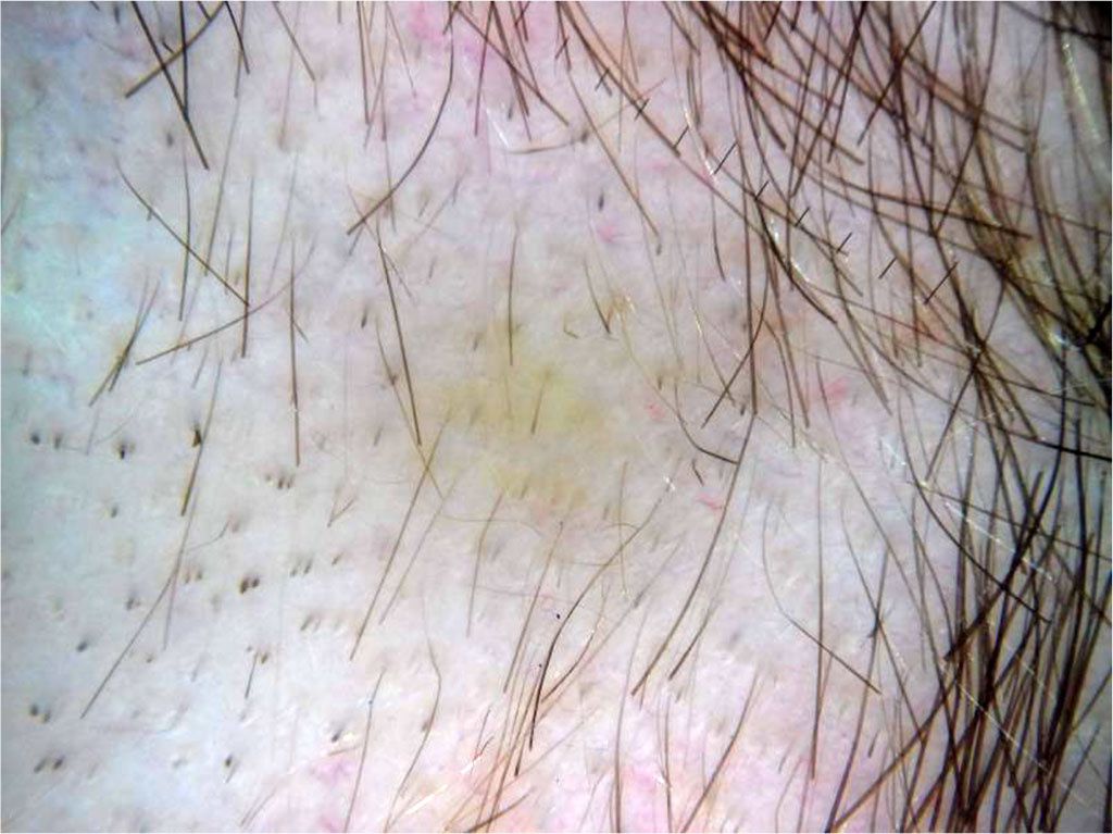 Figure 3: Yellow dots characteristic of alopecia areata as visualized through trichoscopic examination