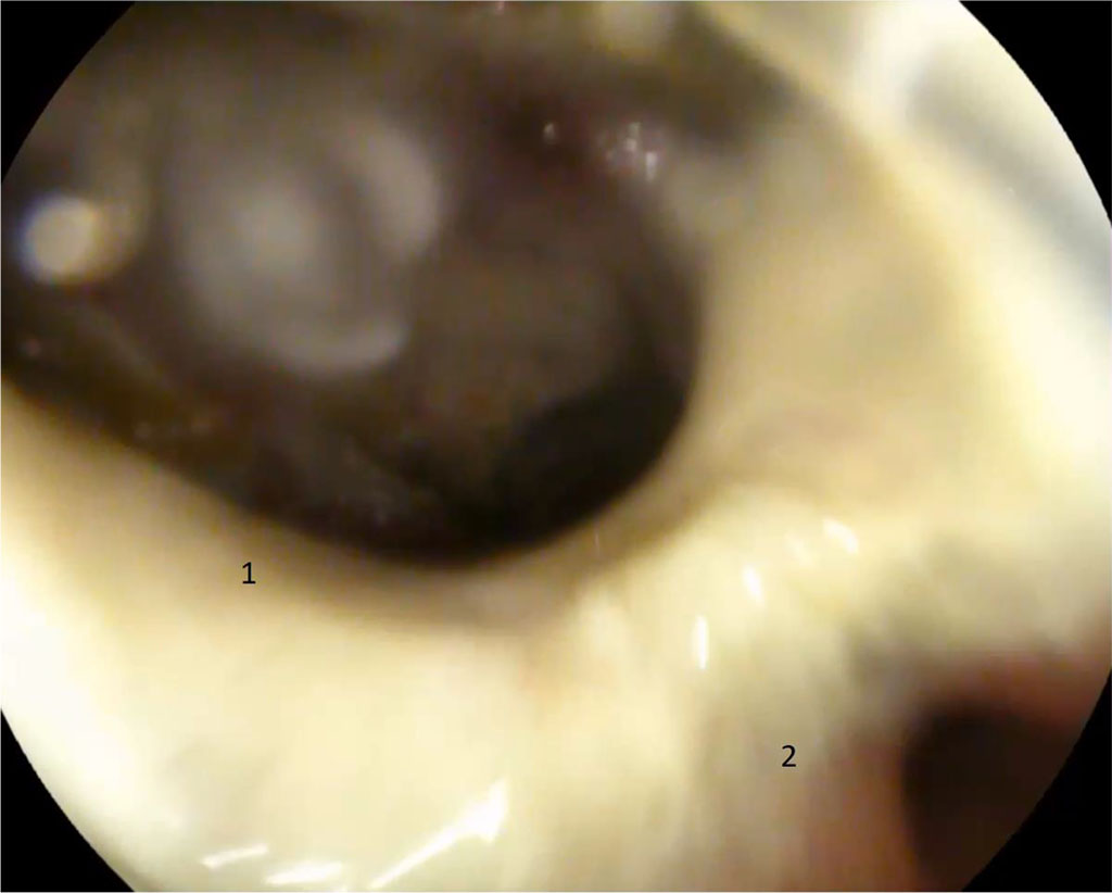 Figure 1. 4 days after surgery. 1 — gastric fistula along the suture line with an orifice into the abdominal abscess; 2 — pyloric part, orifice into the duodenum (explanations in the text)