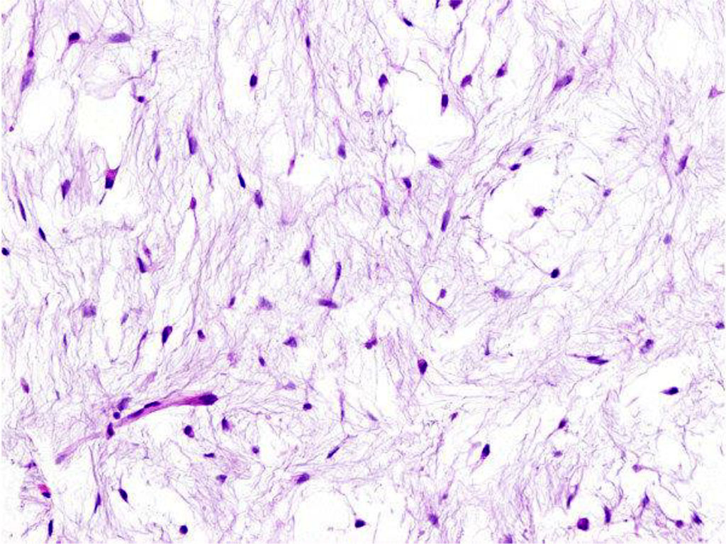 Figure 1. Histologic finding of intramuscular myxoma. The tumour is composed of spindle and stellate-shaped cells in an abundant myxoid stroma.