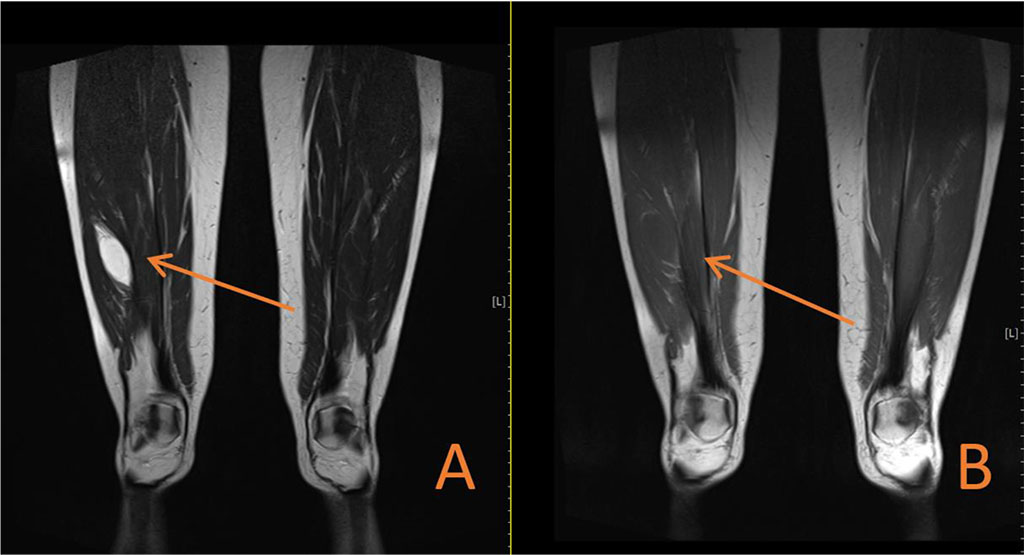 Figure 2. (A) Coronal MRI section showing high signal intensity on T2-weighted imaging in oval-shaped lesion in the Vastus lateralis. (B) Coronal MRI section showing low signal intensity on T1-weighted imaging in oval-shaped lesion in the Vastus lateralis.