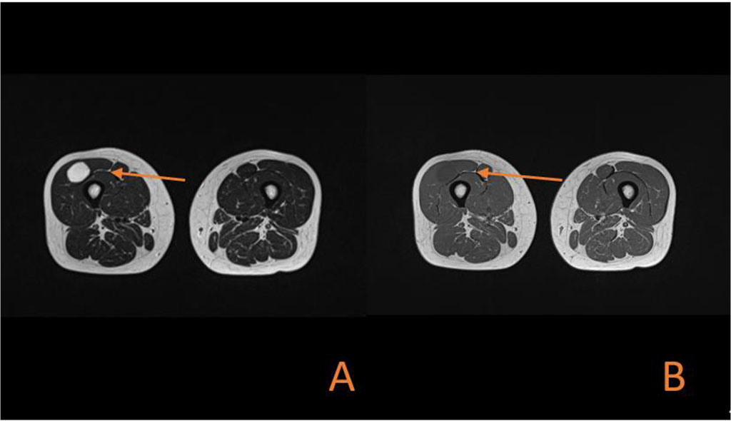 Figure 3. (A) Axial MRI section showing high signal intensity on T2-weighted imaging in oval-shaped lesion in the Vastus lateralis. (B) Axial MRI section showing low signal intensity on T1-weighted imaging in oval-shaped lesion in the Vastus lateralis.