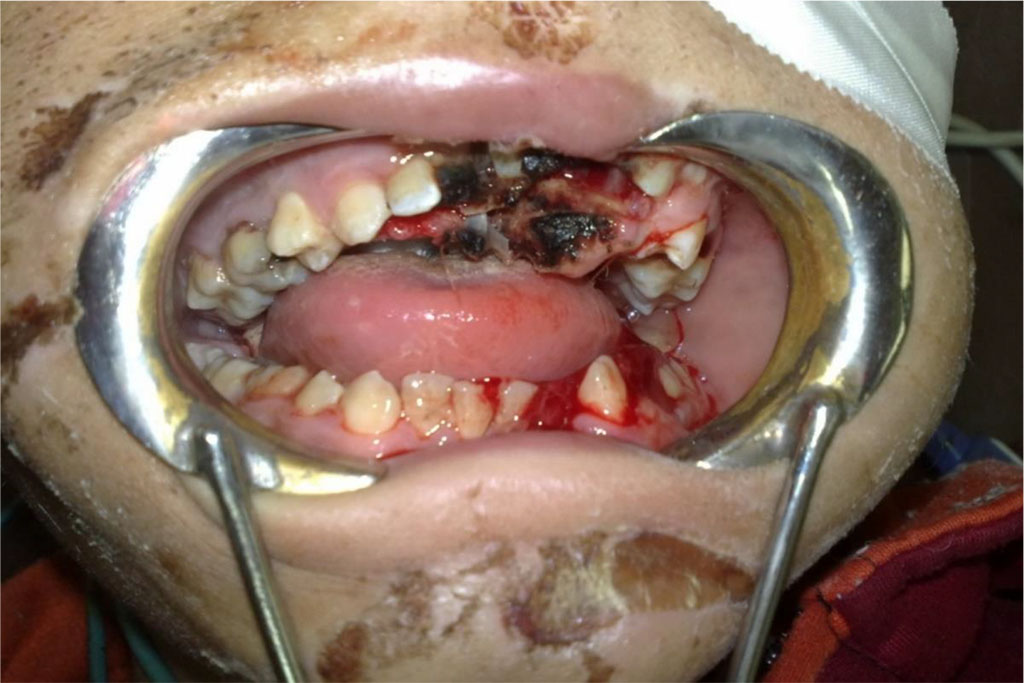 Figure 1: The maxillary Le Fort I and the left parasymphysial mandibular fractures.