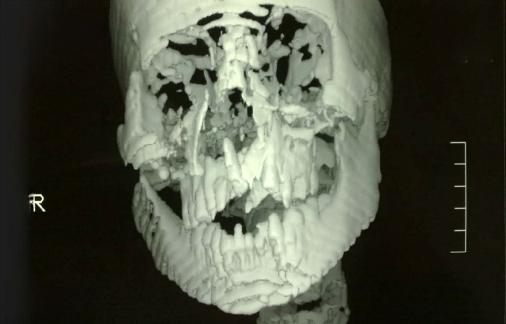 Figure 2: MDCT showing the maxillary Le Fort I and the left parasymphysial mandibular fractures.