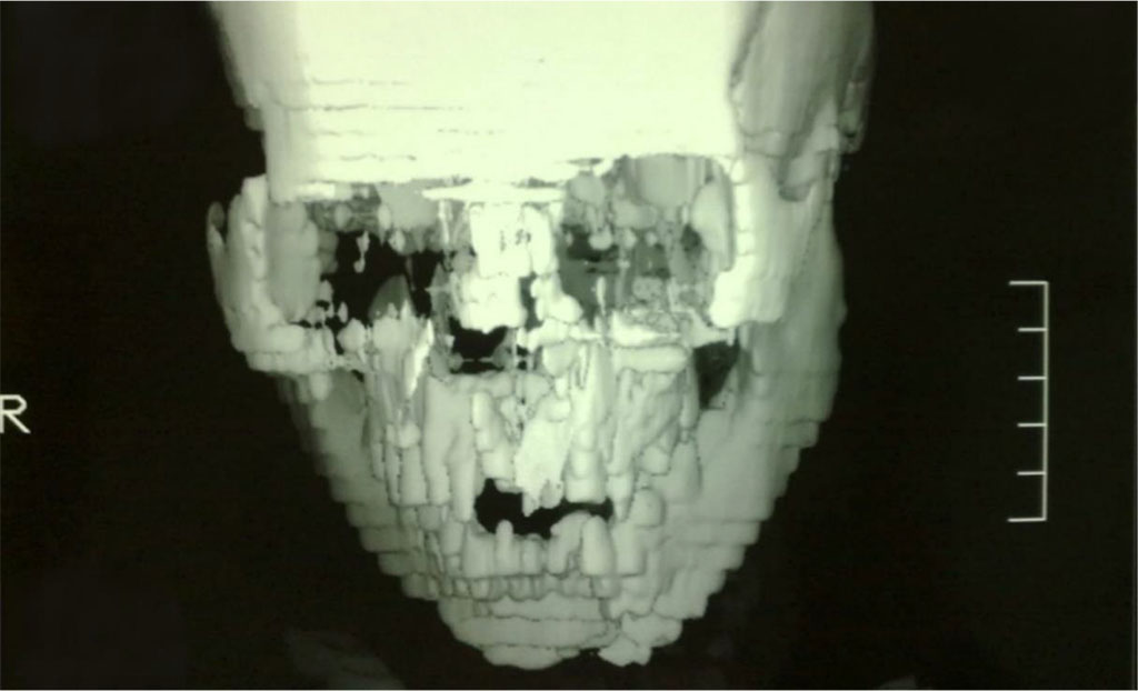 Figure 3: MDCT showing the maxillary Le Fort I and the left parasymphysial mandibular fractures.