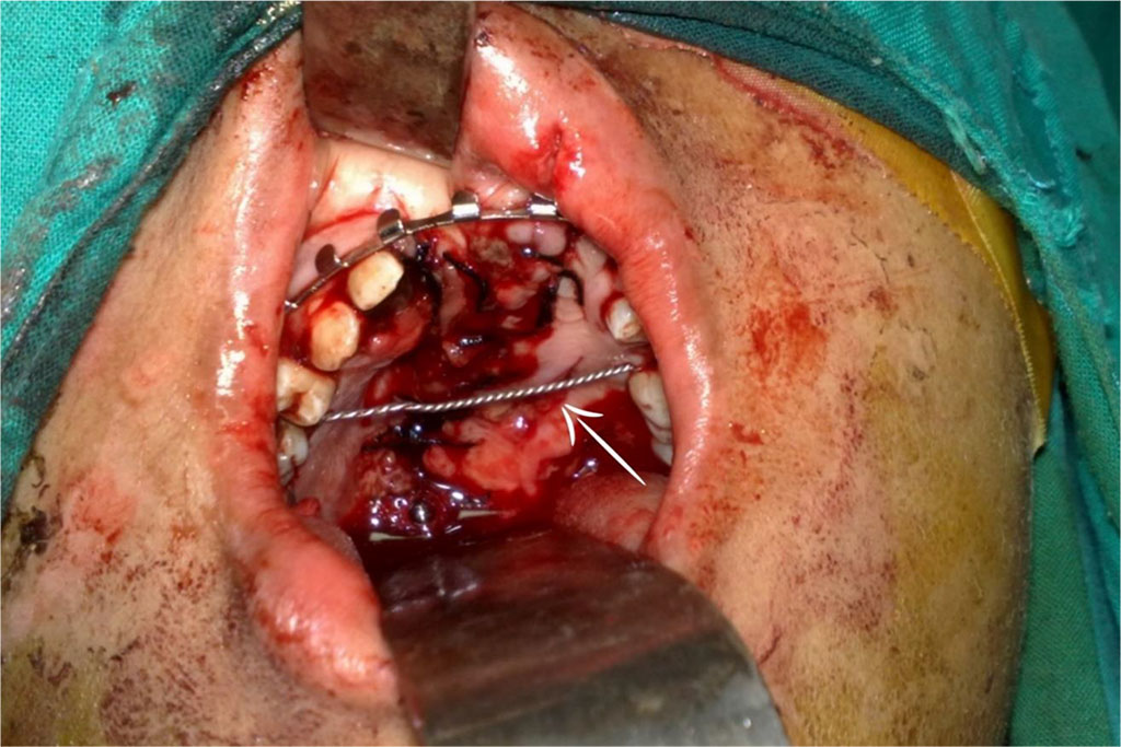 Figure 4: The trans-maxillary wire (The white arrow).