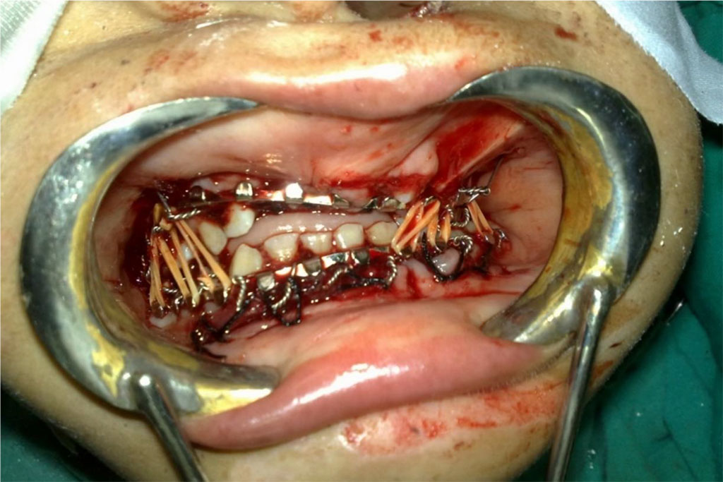 Figure 5: Manduiblo-maxillary fixation.