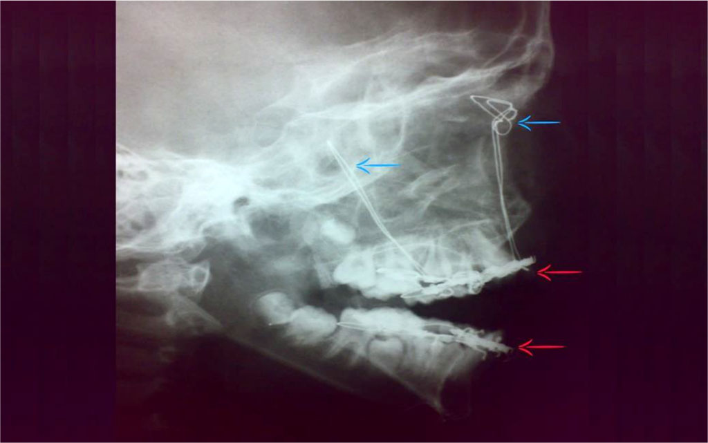 Figure 6: Postoperative plain skull x-ray (lateral view); Frontal suspension (blue arrows) and Manduiblo-maxillary fixation (red arrows).