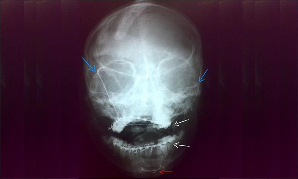 Figure 7: Postoperative plain skull x-ray (Town view); Frontal suspension (blue arrows), Manduiblo-maxillary fixation (white arrows) and interosseus wire (red arrow).