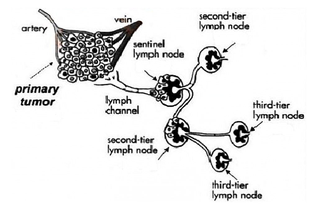 Fig. 2. Scheme of tumor cell dissemination through the sentinel node.