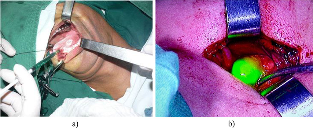 Fig. 3. Indocyanine green was injected at a concentration of 5 mg/1 ml around the tumor in 4 directions (from one injection) a-before, b-after. 